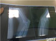 騎行小米九號(hào)平衡車(chē)摔骨折 官方回應(yīng)：雨后路滑