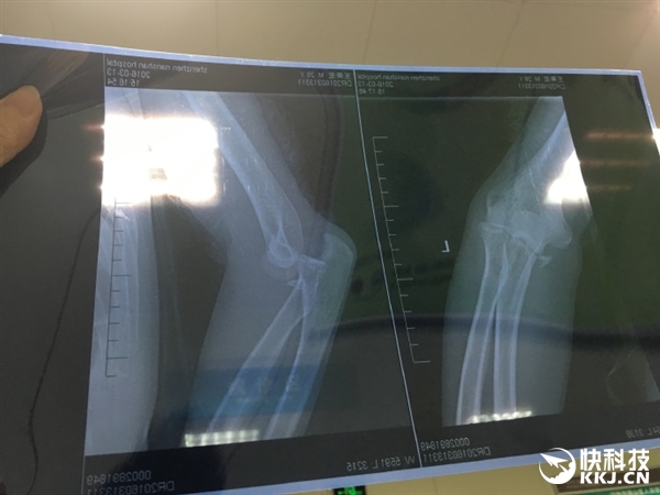 騎小米九號平衡車摔骨折 網友曝實拍視頻真相