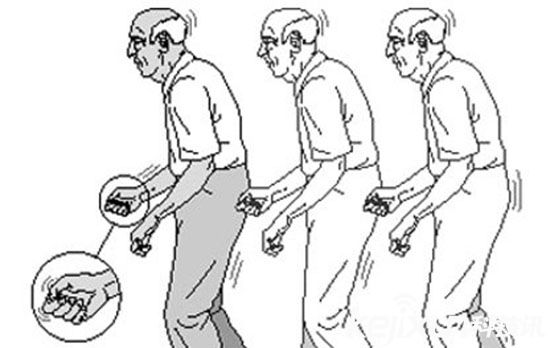 智能穿戴在醫(yī)學(xué)上的擴(kuò)展 帕金森癥用智能穿戴緩解