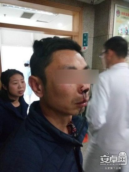 快遞員遭暴打致鼻梁骨折臉部血腫 因要求快遞員實名簽收 快遞員遭暴打致鼻梁骨折臉部血腫 因要求快遞員實名簽收